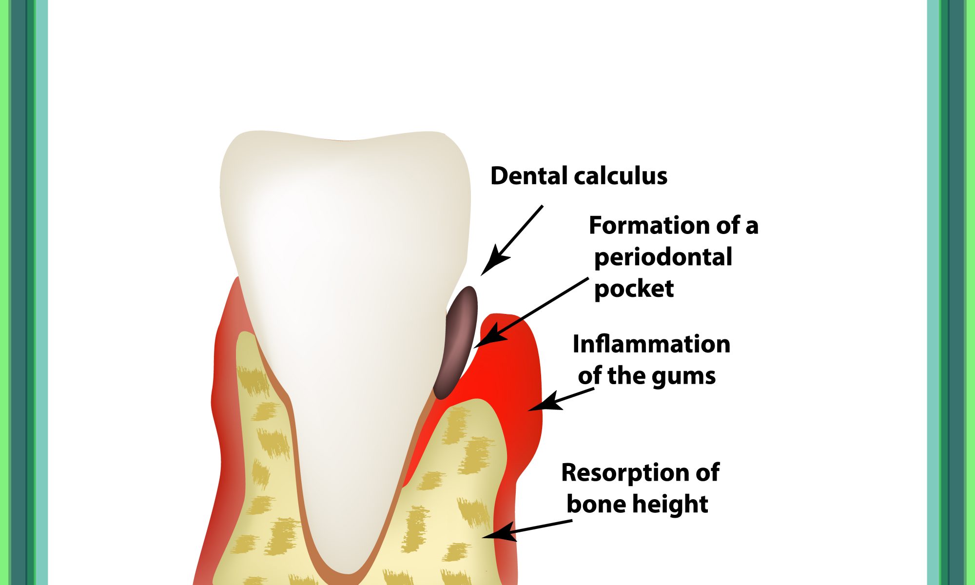 Periodontitis dental disease — inflammation of the gums infographic